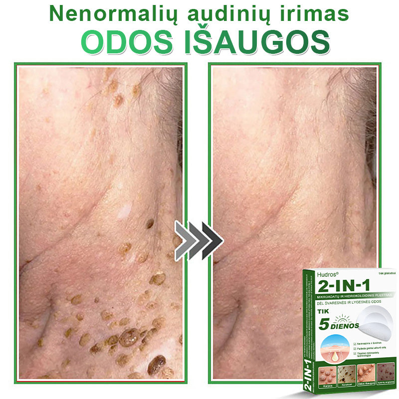 🍄1️⃣ Hudros® 2 viename mikroadatų pleistras – tikslinga pagalba nuo karpų, odos darinių, spuogų ir tamsių dėmių