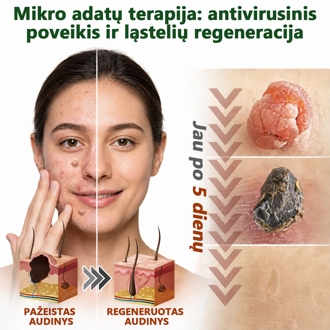 🍄2️⃣Hudros® 2 viename mikroadatų pleistras – tikslinga pagalba nuo karpų, odos darinių, spuogų ir tamsių dėmių