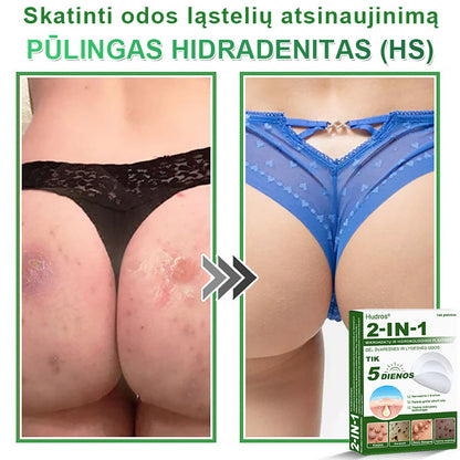 🍄2️⃣Hudros® 2 viename mikroadatų pleistras – tikslinga pagalba nuo karpų, odos darinių, spuogų ir tamsių dėmių