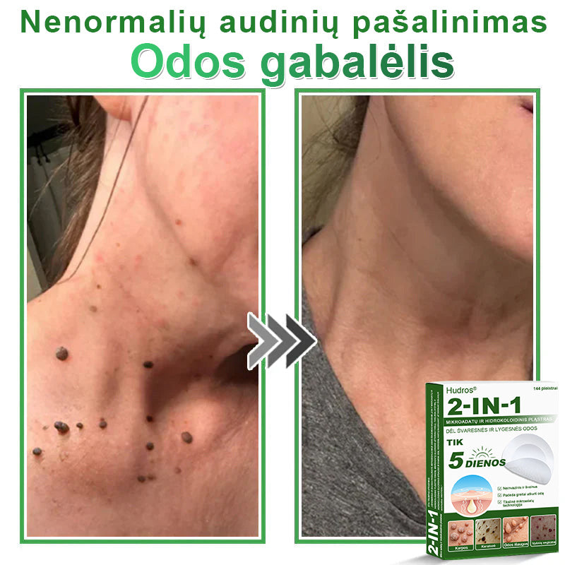 🍄2️⃣Hudros® 2 viename mikroadatų pleistras – tikslinga pagalba nuo karpų, odos darinių, spuogų ir tamsių dėmių