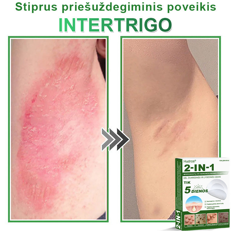 🍄2️⃣Hudros® 2 viename mikroadatų pleistras – tikslinga pagalba nuo karpų, odos darinių, spuogų ir tamsių dėmių