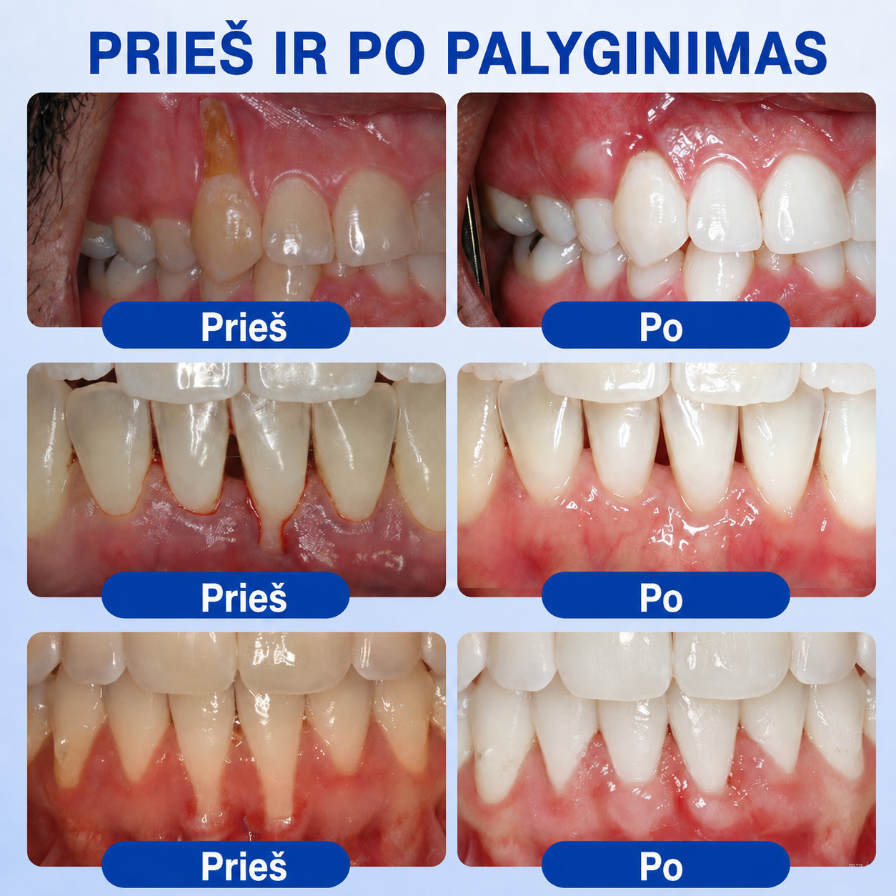 🇱🇹🦷2️⃣ Trilumia® GumRevive – pažangus gelis dantenų ir periodonto priežiūrai