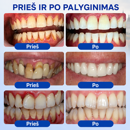 🇱🇹🦷2️⃣ Trilumia® GumRevive – pažangus gelis dantenų ir periodonto priežiūrai